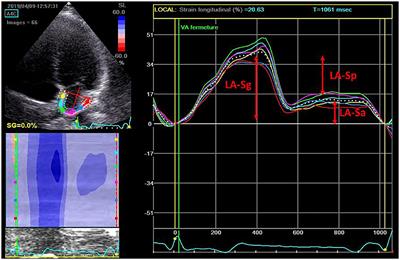 Left Atrial Function in Young Patients With Cryptogenic Stroke and Patent Foramen Ovale: A Left Atrial Longitudinal Strain Study